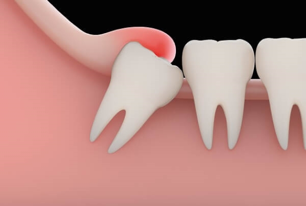 Đối với những bệnh nhân mắc tiêu đường, bệnh tim mạch, ... không nên thực hiện nhổ răng khôn