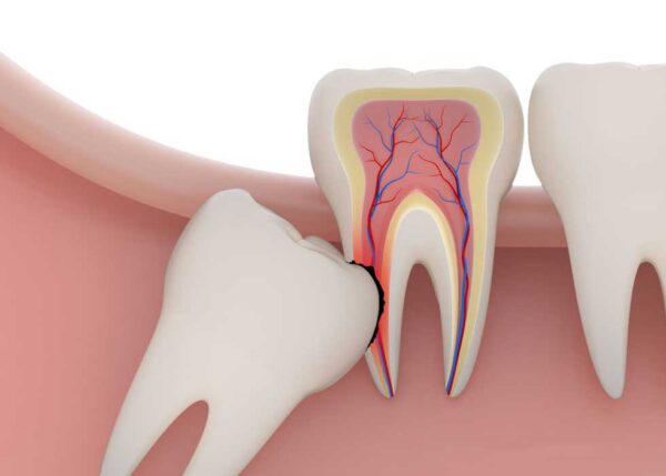 Khi nào nên loại bỏ răng khôn?