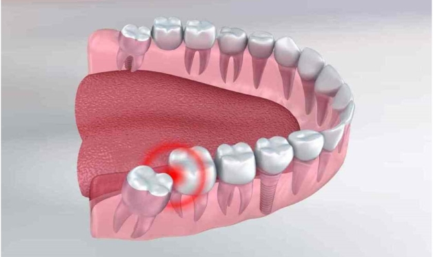 địa chỉ nhổ răng khôn uy tín