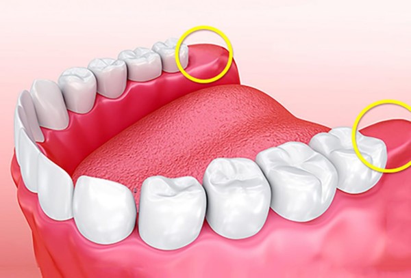 Tùy theo vị trí của răng khôn và tay nghề của bác sĩ mà độ to nhỏ của lỗ hổng sẽ khác nhau