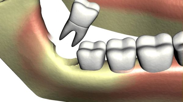 Nếu lỗ hổng sau nhổ lâu lành, cần đi khám lại ngay