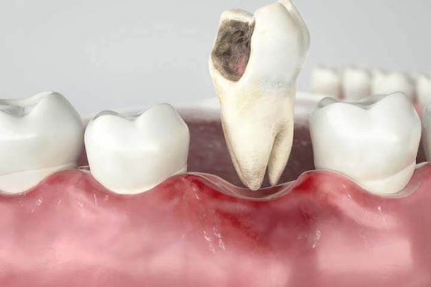 Trong một số trường hợp răng sâu không thể điều trị bảo tồn thì cần nhổ răng sâu để tránh lây lan bệnh