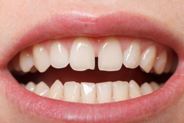 niềng răng bằng nhựa