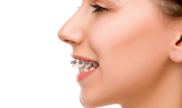 hô hàm có niềng răng được không