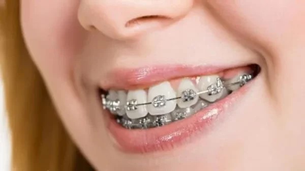 Răng hô nhẹ là tình trạng khá phổ biến ở nhiều người