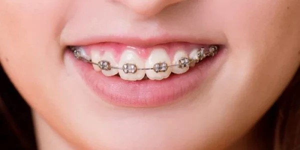 Răng hô có thể ảnh hưởng đến chức năng ăn nhai