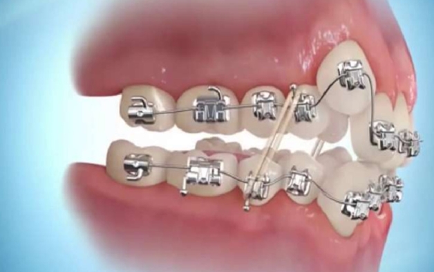 Có 3 phương pháp phổ biến thường được áp dụng để niềng răng khểnh