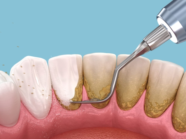 Tìm hiểu nước súc miệng loại bỏ cao răng