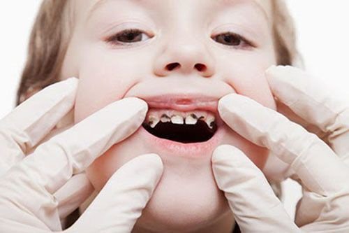 phác đồ điều trị tủy răng sữa
