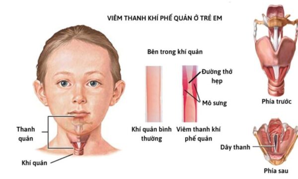 Trẻ viêm thanh khí phế quản cần được điều trị với phác đồ phù hợp