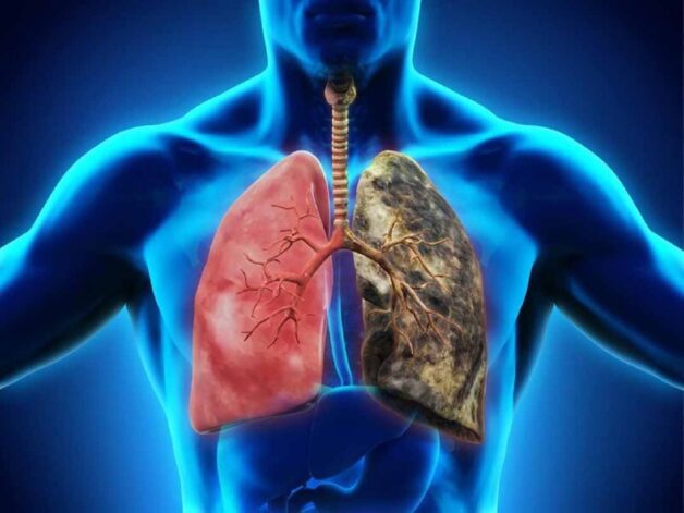 Phân biệt viêm phổi và viêm phế quản