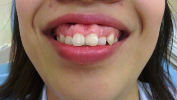 Những yếu tố ảnh hưởng đến chi phí cuối cùng của phẫu thuật hở lợi