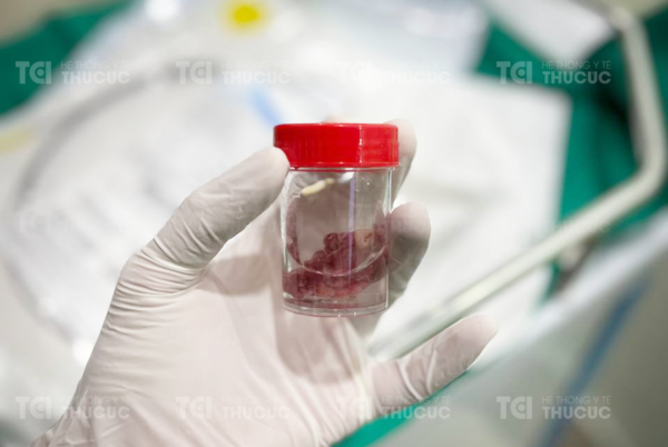 Polyp trực tràng sau cắt