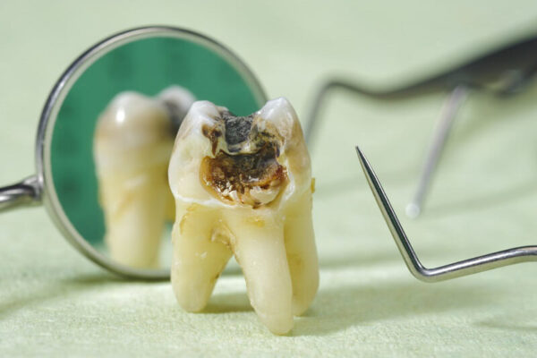 Quá trình bị sâu răng đến vào phần tủy răng