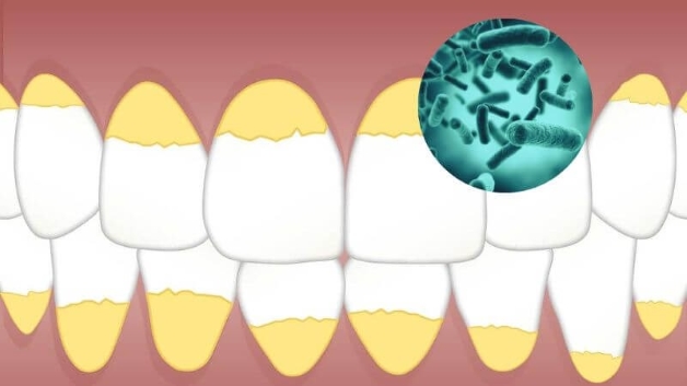 Răng bị vôi bám nhiều