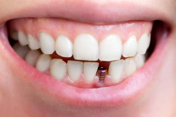 Người đã mất răng và không muốn sử dụng hàm tháo lắp, răng cấy ghép implant