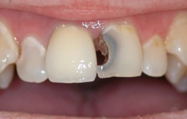 Vệ sinh răng miệng chưa đúng cách là nguyên nhân khiến răng cửa bị sâu
