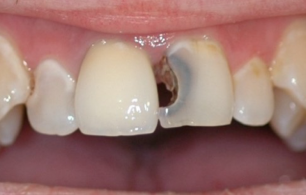 Cách xử lý răng cửa bị sâu và mẻ tối ưu chi phí đảm bảo thẩm mỹ-1