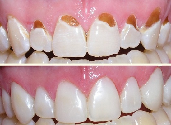 răng cửa bị sâu và mẻ
