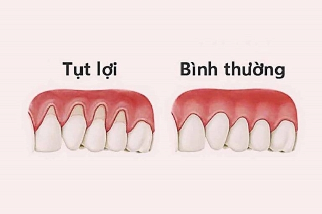 răng lung lay