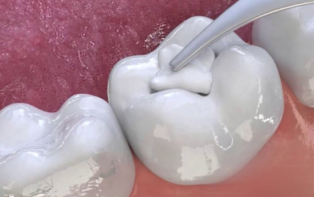 răng số 5 hàm dưới bị sâu