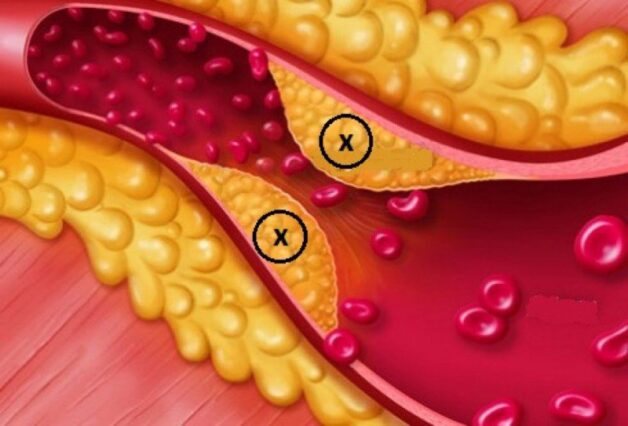 Đánh giá giai đoạn phục hồi chức năng sau đột quỵ