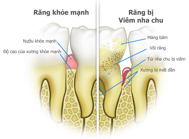 cách sạch cao răng tại nhà