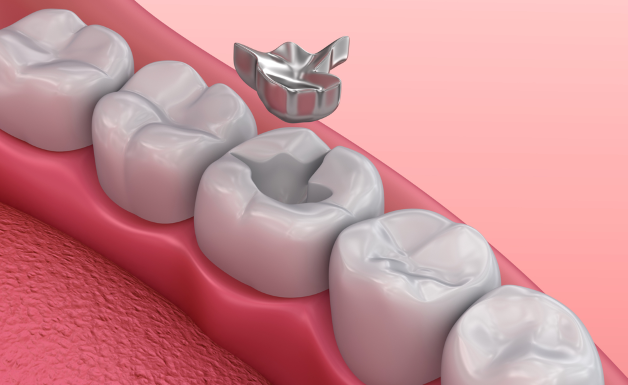 Hàn trám được áp dụng trong điều trị răng sâu khá phổ biến giúp phục hình răng và lấp đi các lỗ sâu trên răng