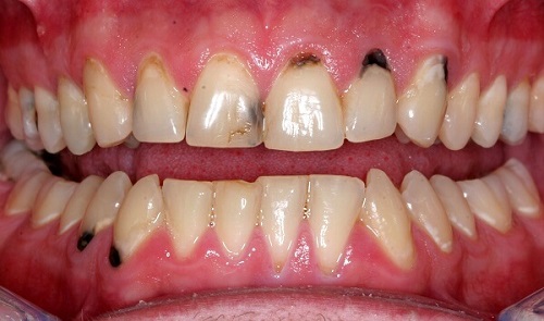 Cấu trúc ban đầu của răng cửa