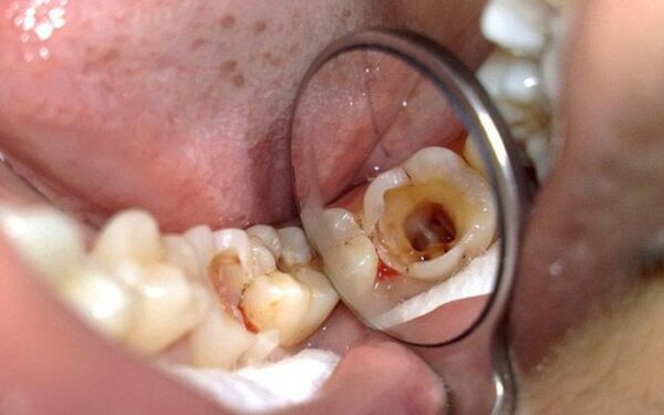 Sâu răng càng nặng càng dễ có nhiều biến chứng nguy hiểm