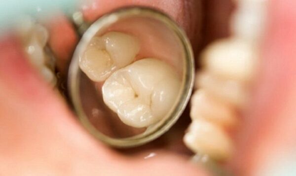 Dấu hiệu cảnh báo sâu răng mới chớm