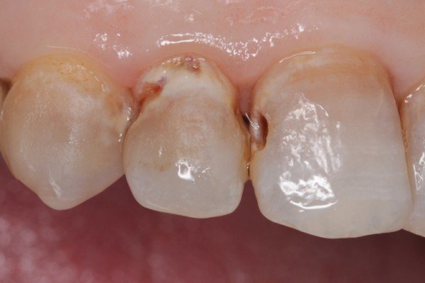 Sâu răng nhẹ là tình trạng gì?
