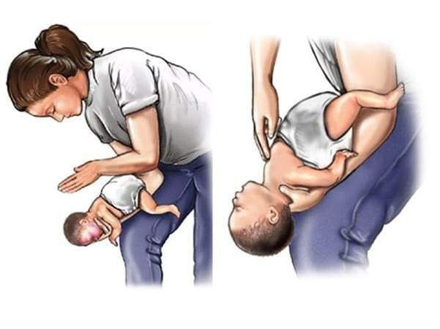 phương pháp sơ cứu hóc dị vật