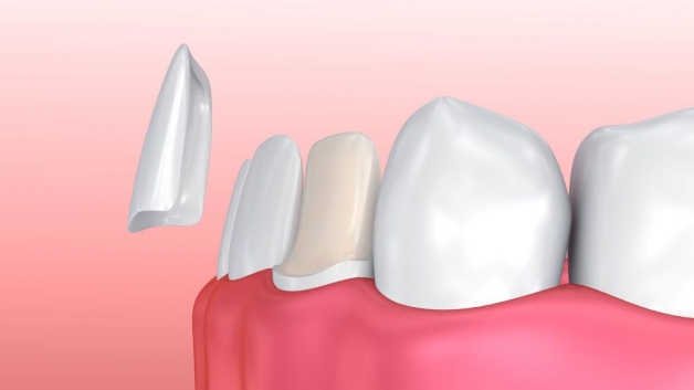 dán sứ Veneer
