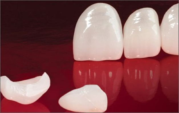 răng dán sứ Veneer