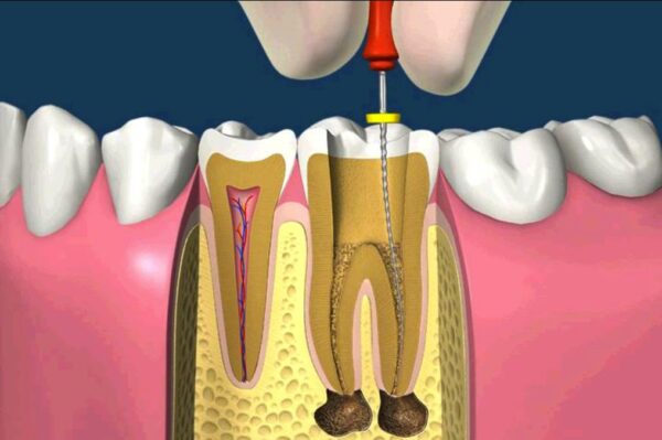 Tại sao sâu răng phải lấy tủy