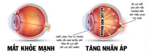 Giải đáp bệnh tăng nhãn áp xử trí hiệu quả-1