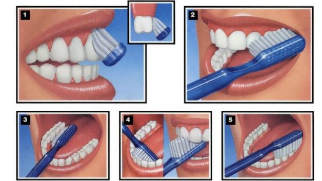 thực hiện tẩy mảng bám trên răng