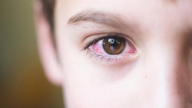 Tư vấn người bệnh đau mắt đỏ uống thuốc gì
