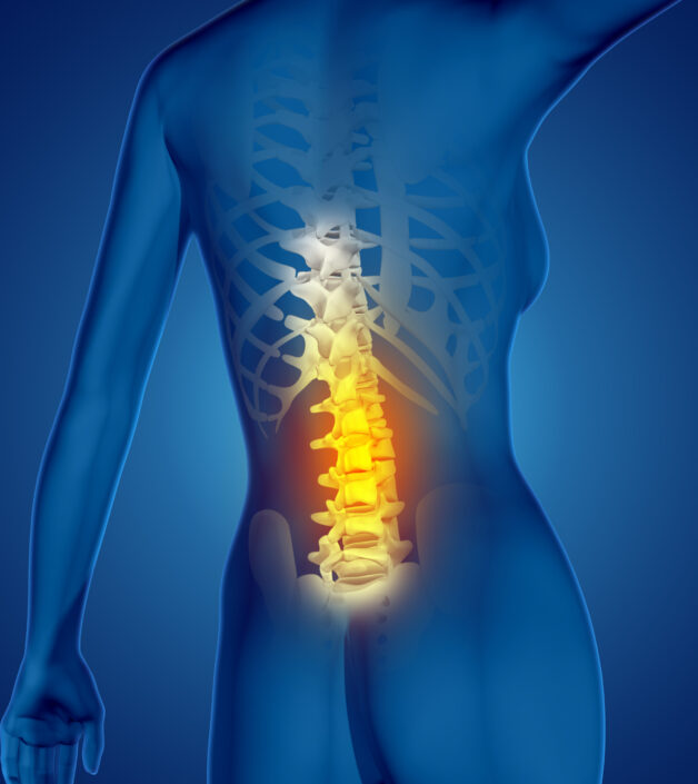 Thoát vị đĩa đệm là gì