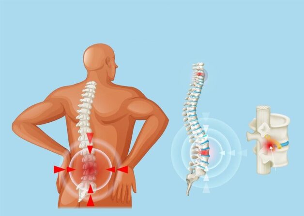 Thoát vị đĩa đệm là đau ở đâu? Vị trí tùy thuộc vào loại bệnh bạn đang gặp phải