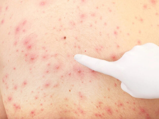 thời gian lây bệnh thủy đậu