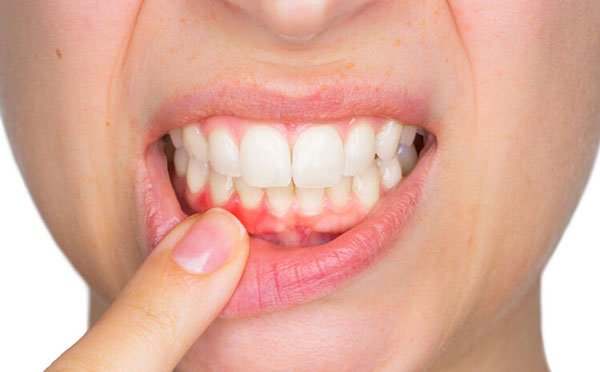 thuốc bôi viêm nướu răng