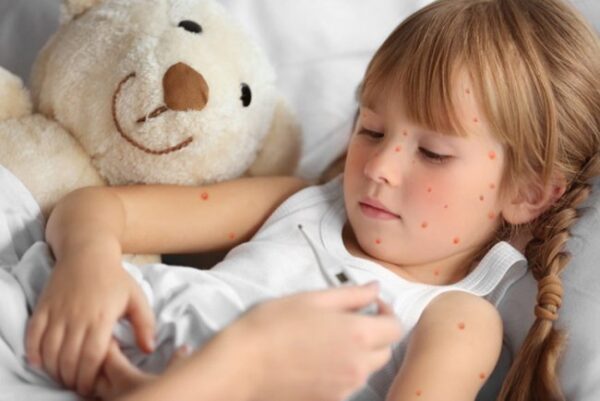 Trẻ mắc thủy đậu được uống thuốc điều trị đúng cách sẽ giảm nguy cơ biến chứng nặng