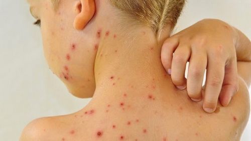 7 điều cần biết để phòng và điều trị bệnh thủy đậu ở trẻ hiệu quả-1