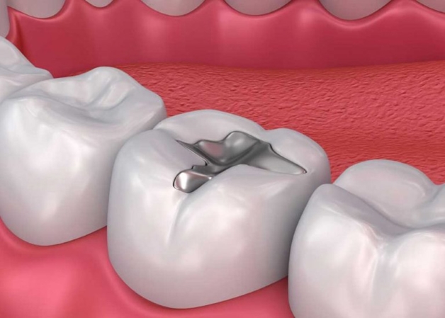 trám răng sâu lỗ nhỏ