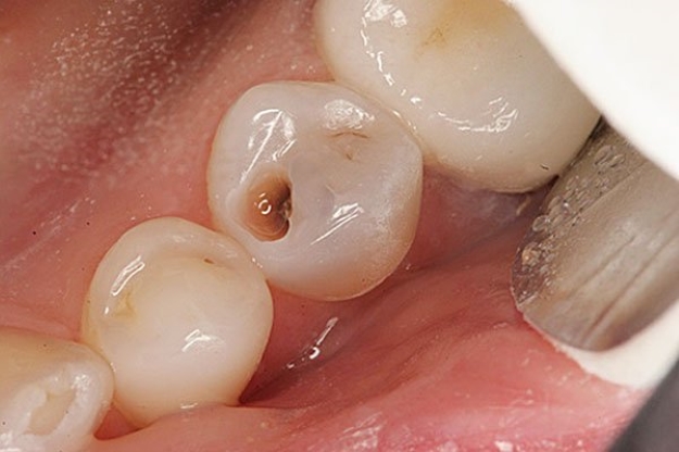 trám răng sâu lỗ nhỏ