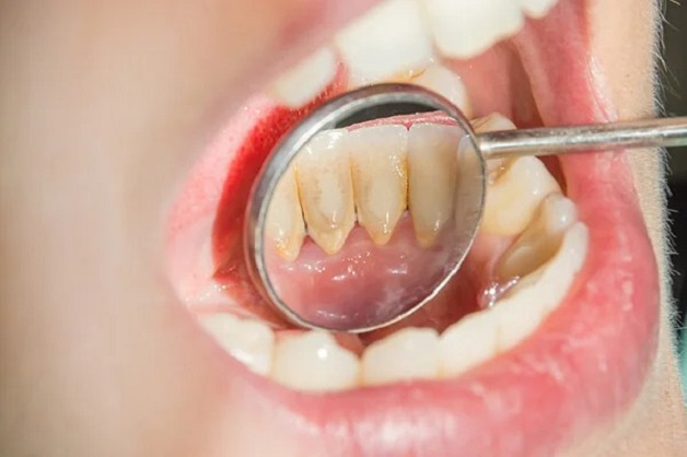 trị cao răng đơn giản tại nhà