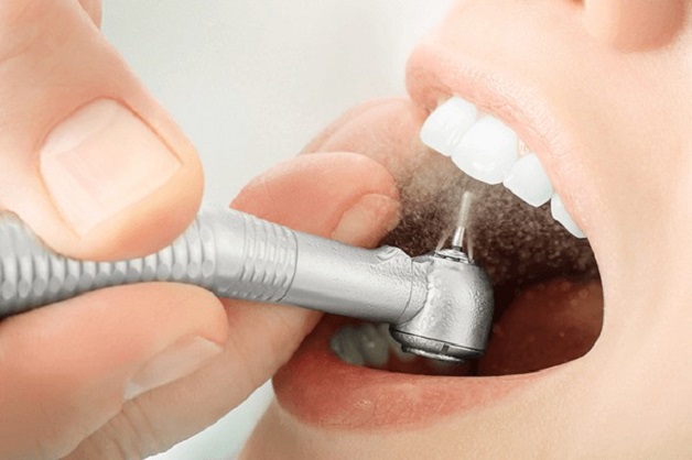 Lấy cao răng tại nha khoa bằng các dụng cụ chuyên dụng