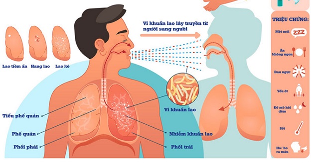 Triệu chứng của người nhiễm vi khuẩn lao